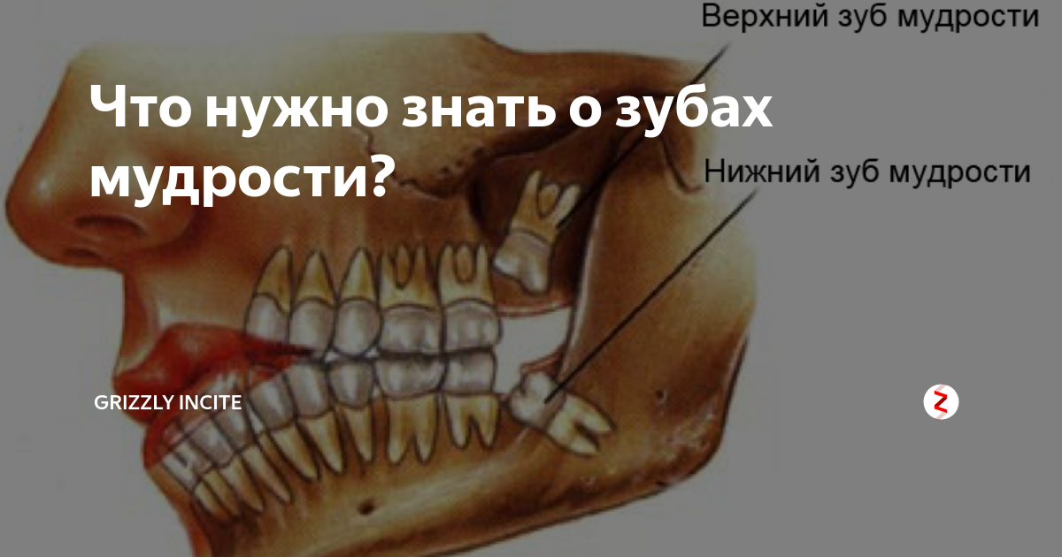 Анатомия зубов мудрости. Зубы без зубов мудрости.