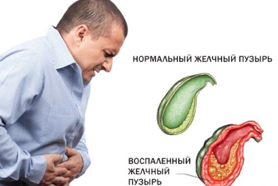 Лечение желчекаменной болезни без операции: диета, народные методы