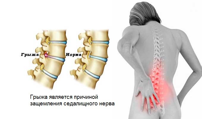 Симптомы и лечение при защемлении седалищного нерва