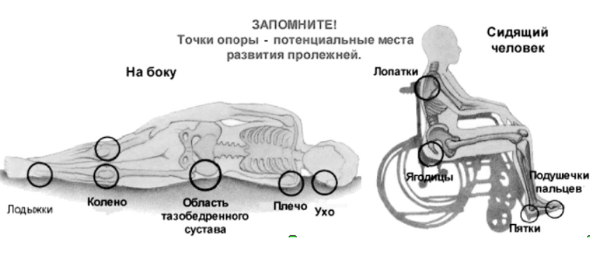 рисунок: места образования пролежней.