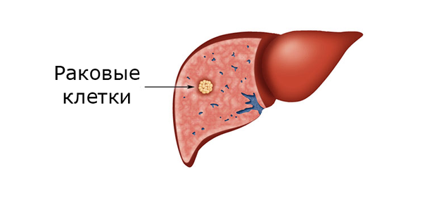 6 причин рака печени