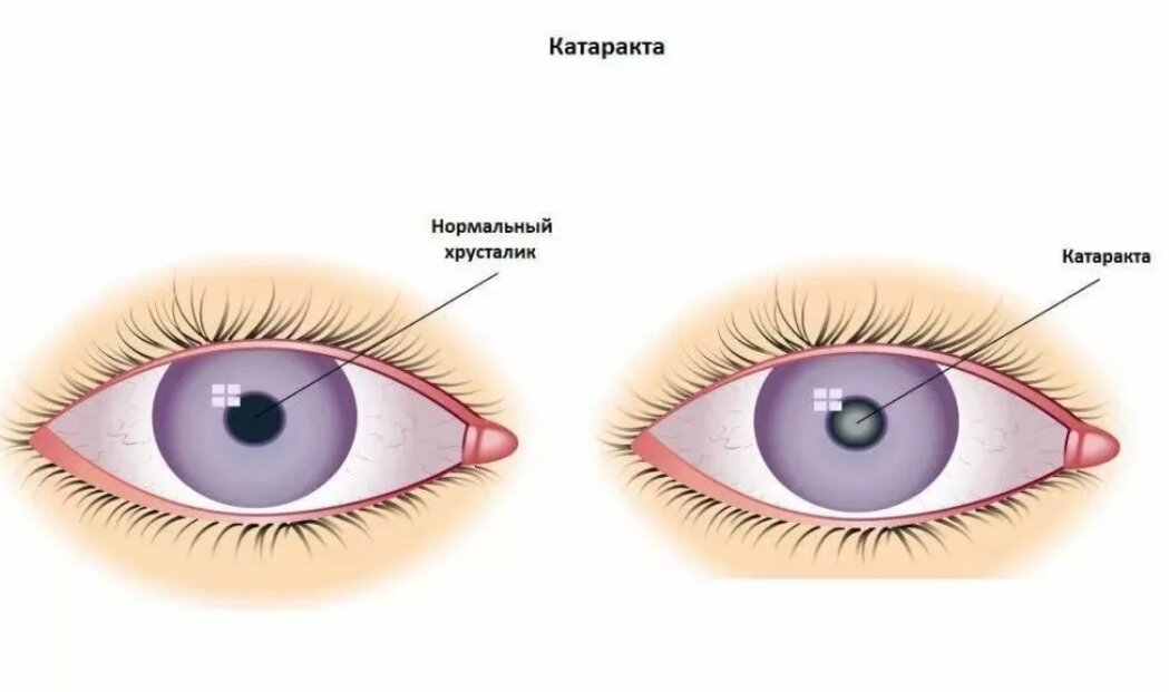 Симптомы катаракты. Ирит конъюнктивит увеит. Иридоциклит глазная болезнь. Абсцедирующий халязион.