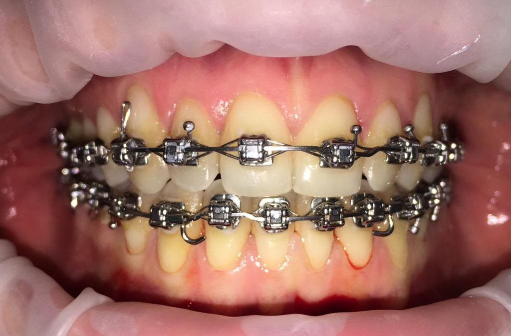 Брекет-система Damon Q