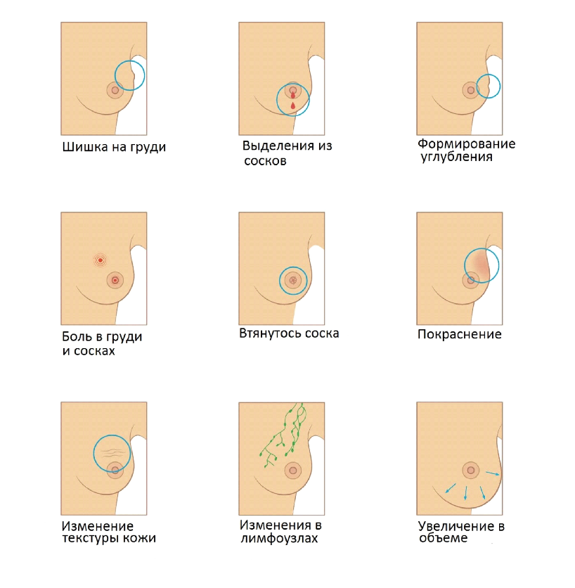 Рак груди у мужчин: причины, симптомы, лечение