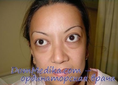  Глазные симптомы типичны для тиреотоксикоза.