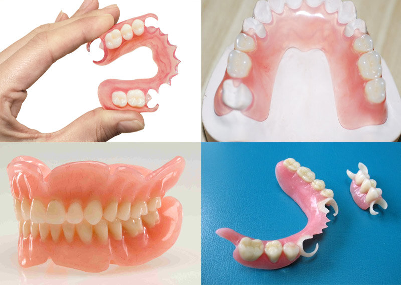 Какие зубные протезы лучше при отсутствии зубов. Частичный съемный протез Flexi n512. Нейлоновый протез Flexite.