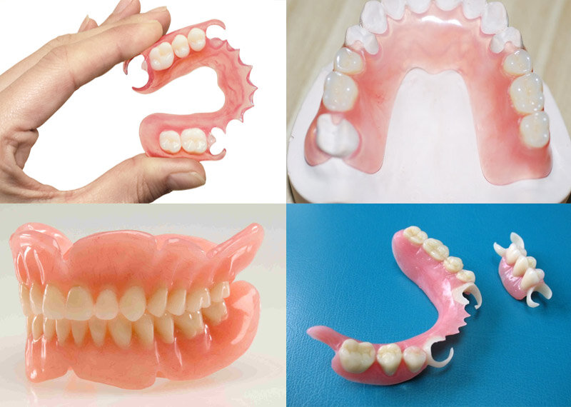 Облегченные протезы. Частичный съемный протез Flexi n512. Нейлоновый протез Flexite.