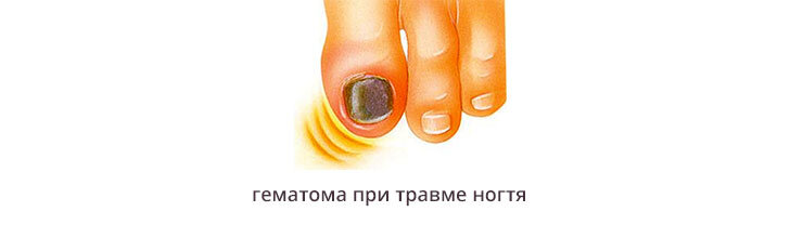 Гематома часто приводит к деформации ногтя