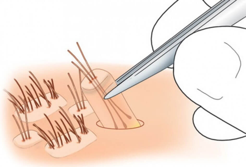 Как вырвать луковицу на брови