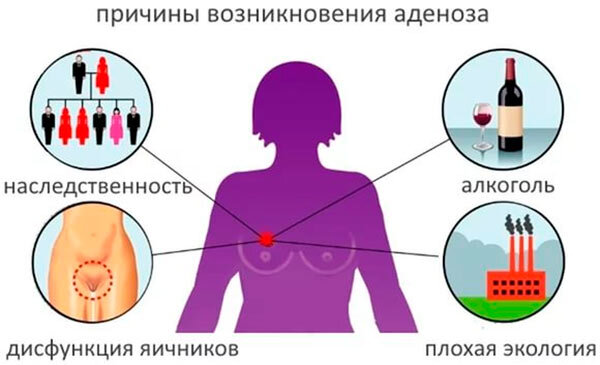 Аденоз молочной железы: диагностика, лечение и прогноз