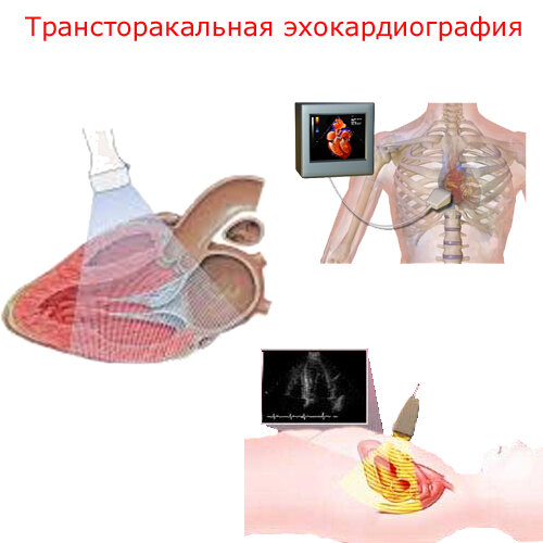 трансторакальная эхокардиография