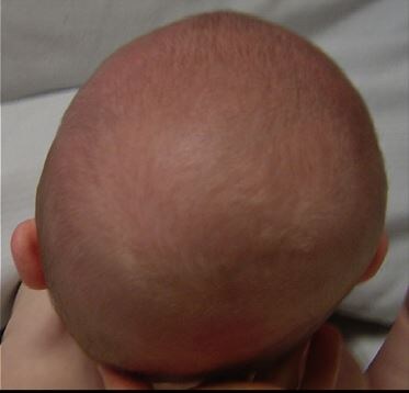 Рисунок 2. Характерная форма головы ребенка 2 мес. при плагицефалии.
S. Lessard, I. Gagnon, N. Trottier. Exploring the impact of osteopathic treatment on cranial asymmetries associated with nonsynostotic plagiocephaly in infants