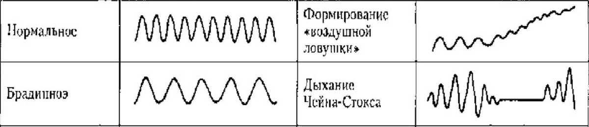 Типы дыхания куссмауля чейна стокса биота. Дыхание биота и чейна стокса. Дыхание чейн-стоqса. Патологическое дыхание чейна стокса. Типы дыхания куссмауля чейна стокса биота.