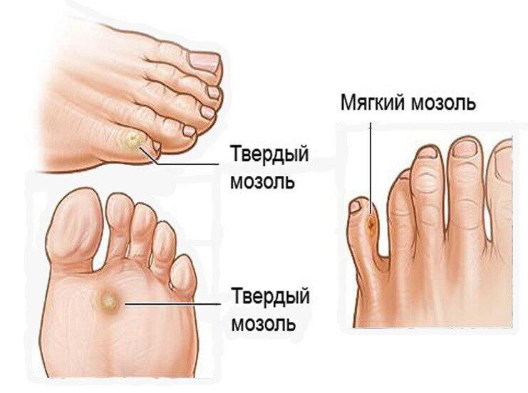 Виды мозолей