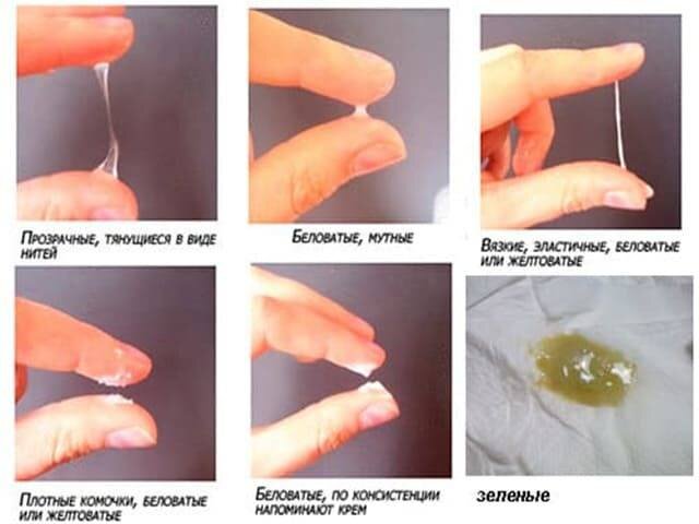 Типы и виды выделений у женщин, белые, прозрачные, творожистые.