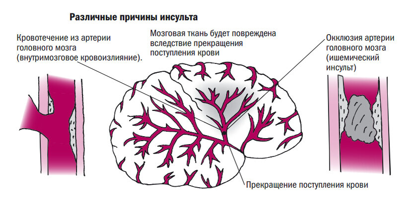 Инсульт у детей последствия. Ишемический инсульт причины возникновения. Факторы возникновения инсульта. Церебральный инсульт причина. Предпосылки ишемического инсульта.