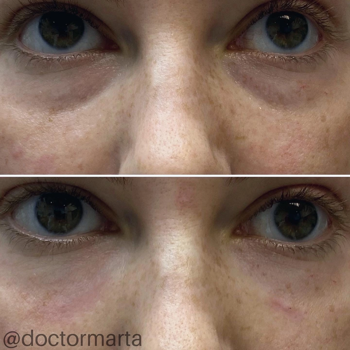 Сверху - фото до заполнения носослезной борозды филлером Apriline forte, снизу - сразу после 