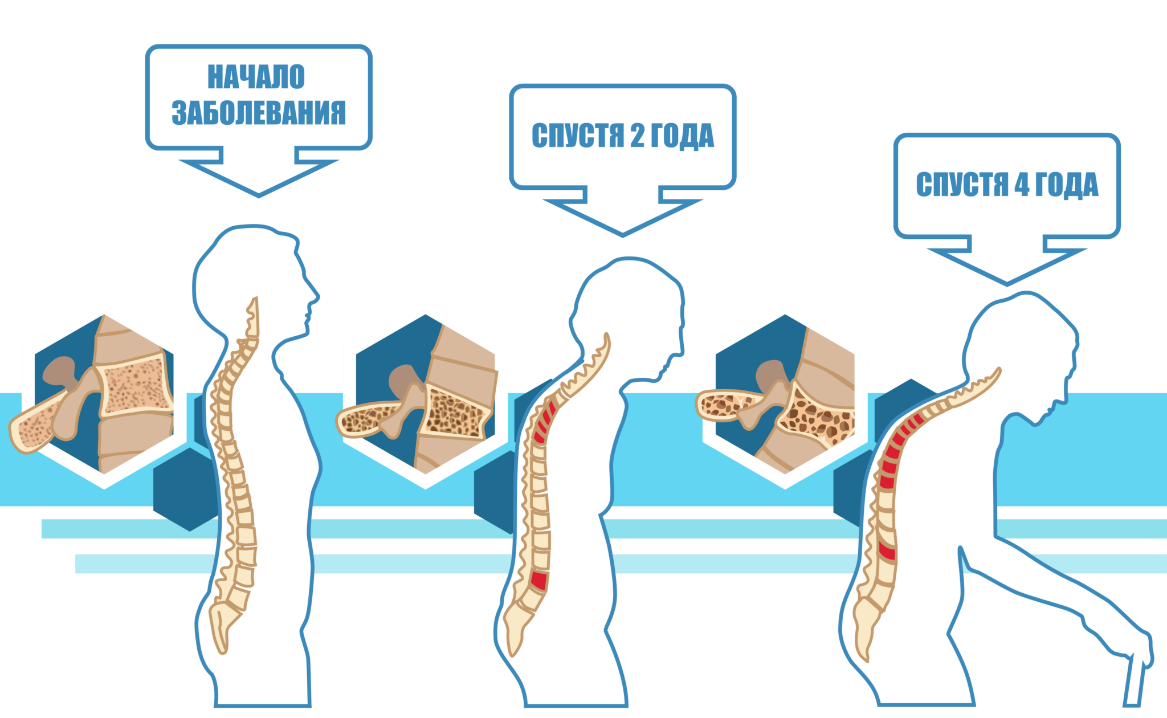 Уменьшение костной ткани. Остеопороз симптомы. Остеопороз позвоночника. Остеопороз позвоночника симптомы. Профилактика остеопороза.