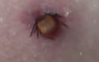 Присосался энцефалитный клещ в тайге удаляем - (смотрите на видео внизу статьи)