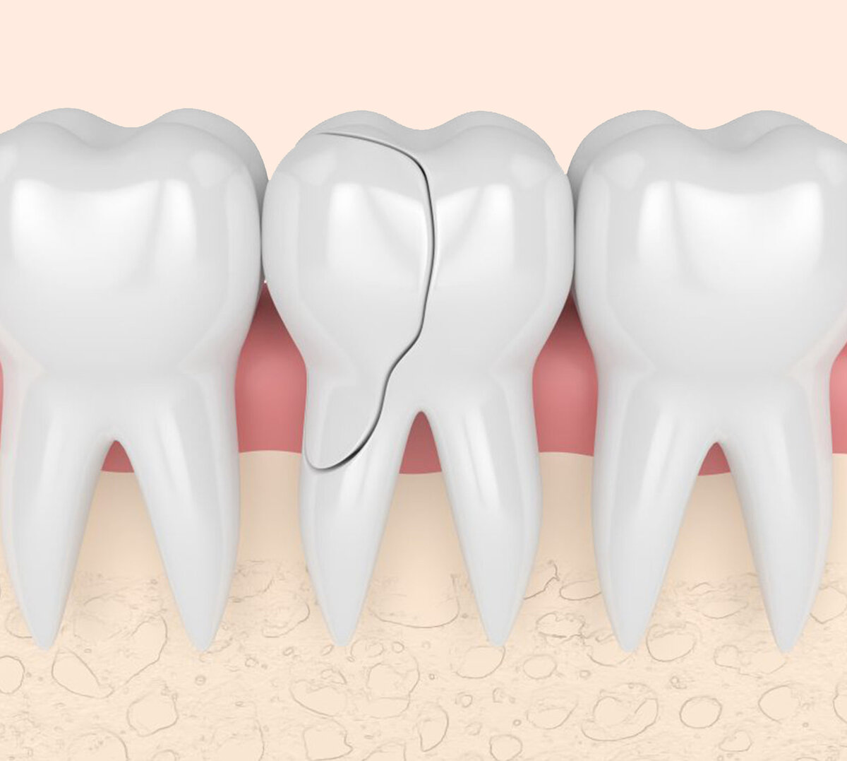 Что делать если треснул зуб и раскололся: первая помощь и лечение при появлении трещины на зубах