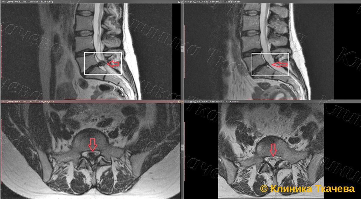 Резорбция грыжи. Мрт грыжа s1-s2. Стеноз позвоночного канала l5-s1.