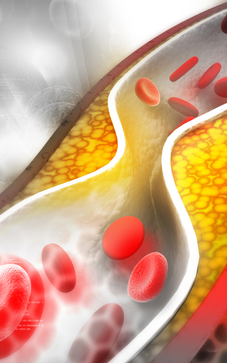 Нездоровый сосуд. Фото с просторов интернета