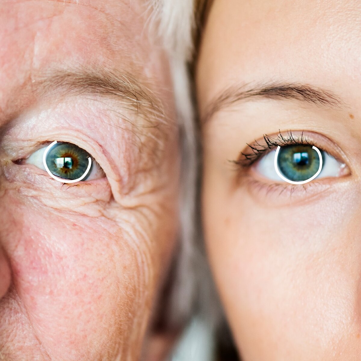 возрастные изменения глаза. возрастная старческая катаракта. офтальмолог катаракта. сенильная катаракта глаза. как лечить катаракту глаза в пожилом возрасте.