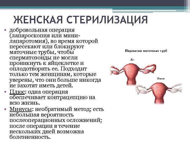 Женская стерилизация презентация