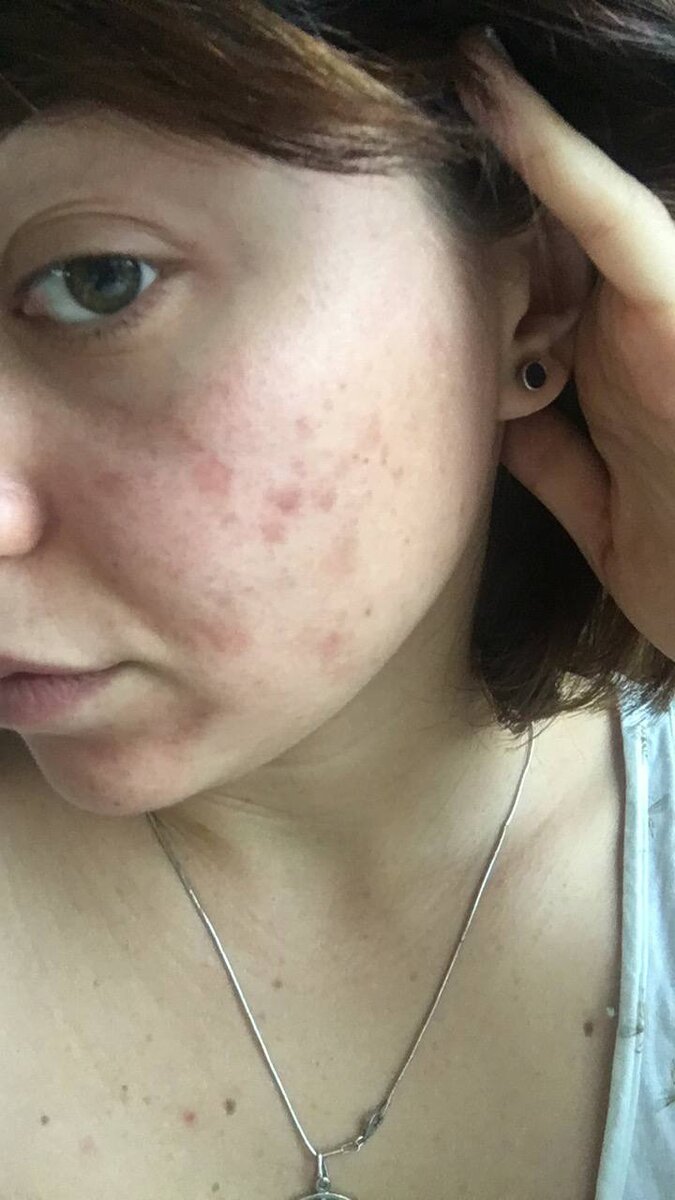 Последствия пилинга Джеснера