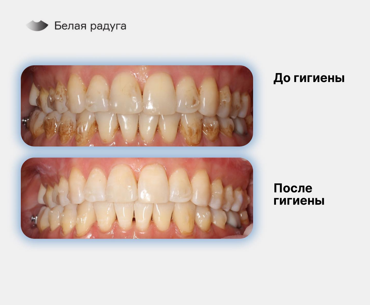 Элайнеры для выравнивания зубов: фото до и после