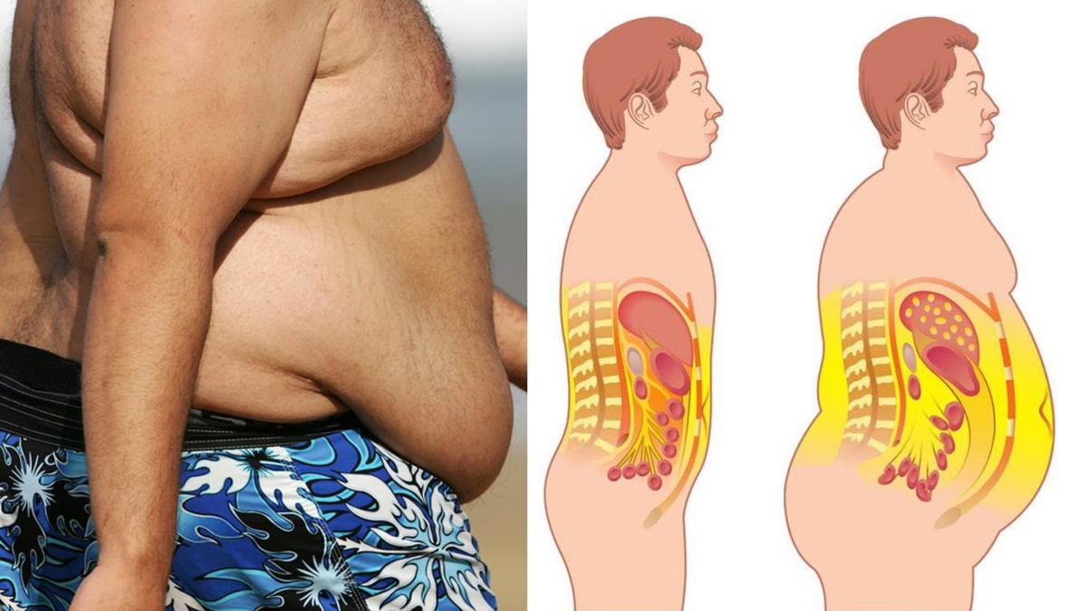 Легкое ожирение. Висцеральный жир анатомия. Висцеральное ожирение.