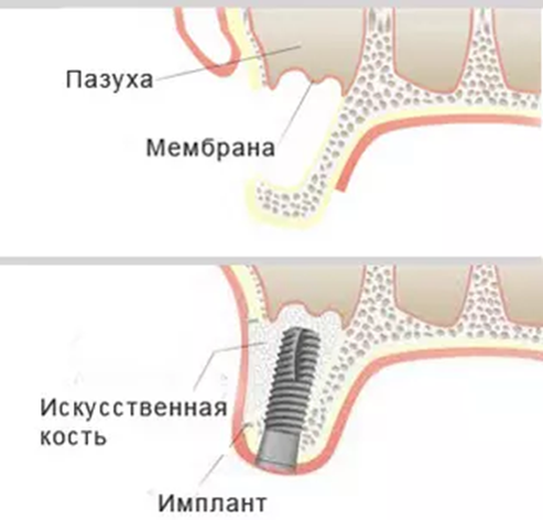 Схема восстановления костной ткани