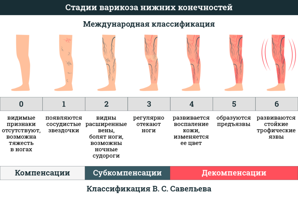Варикозная болезнь стадии фото Варикоз какие лечение