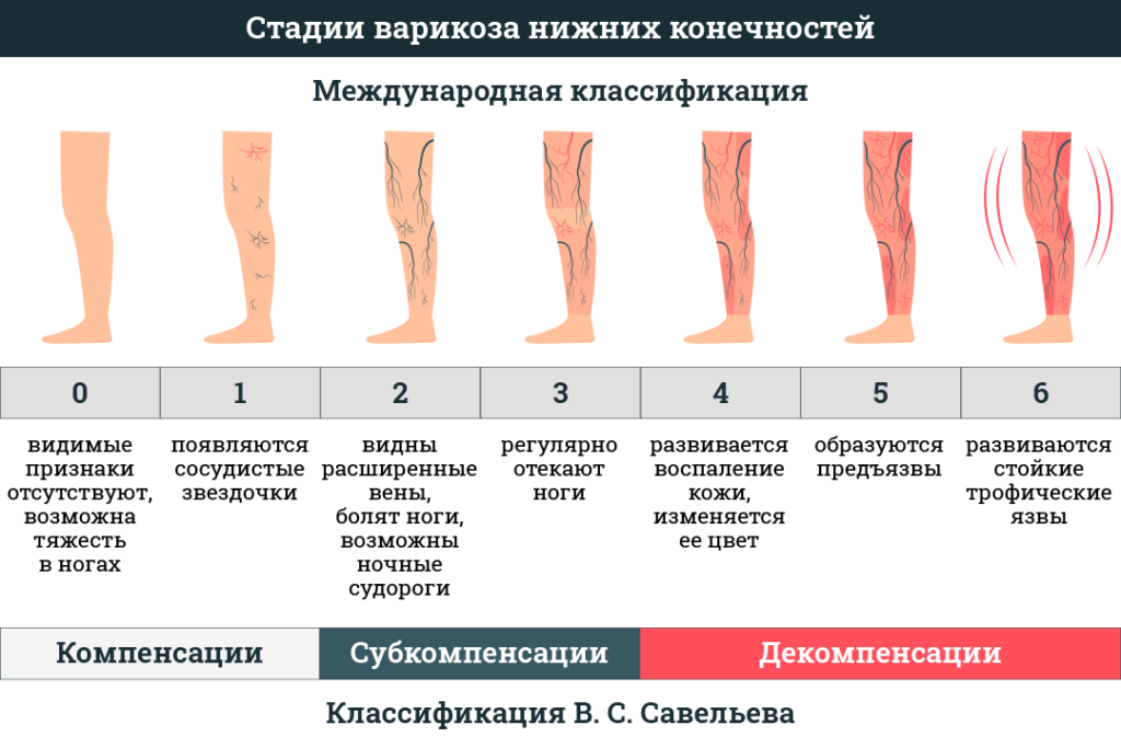 Варикоцеле: степени, симптомы, лечение