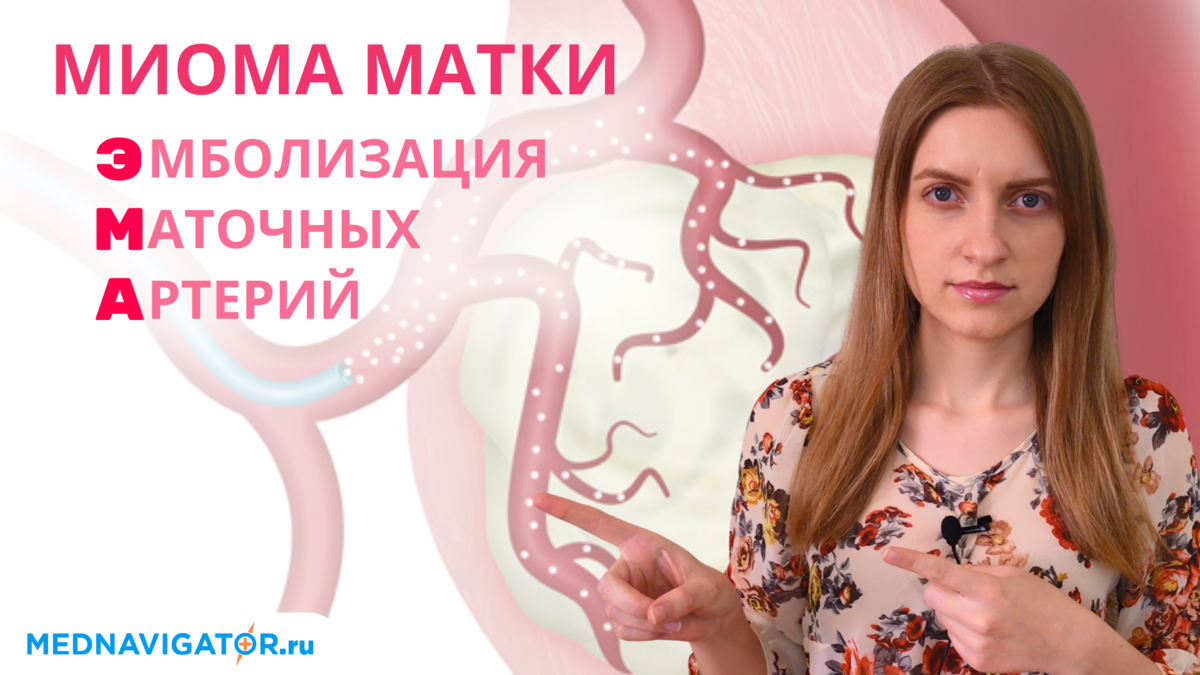 Удаление миомы матки методом ЭМА - эмболизация маточных артерий |  Mednavigator.ru | Дзен