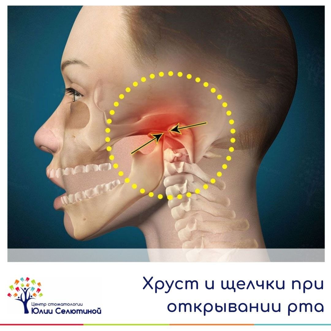 скулы после удаления зубов мудрости фото