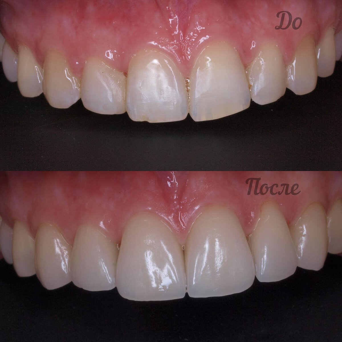 Керамические Виниры. Выполнены с минимальным препарированием зубов. 