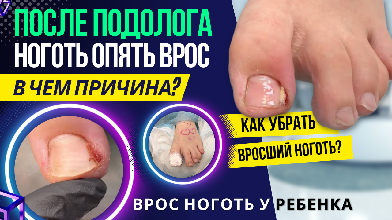 Врастание ногтевой пластины на пальцах рук.