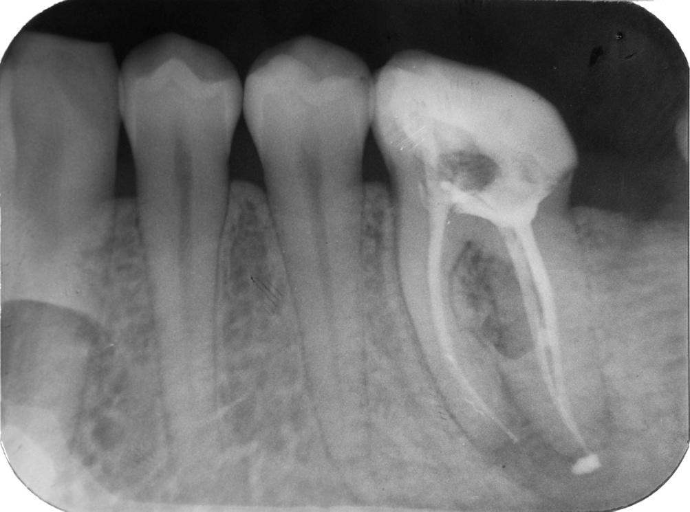 Может ли болеть зуб с удаленным нервом и почему?