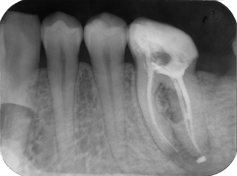 Запломбировать удаленный нерв. Пломбировка каналов зуба рентген. Травматический пульпит. Рентген запломбированных каналов зуба. Пульпит пломбировка каналов.