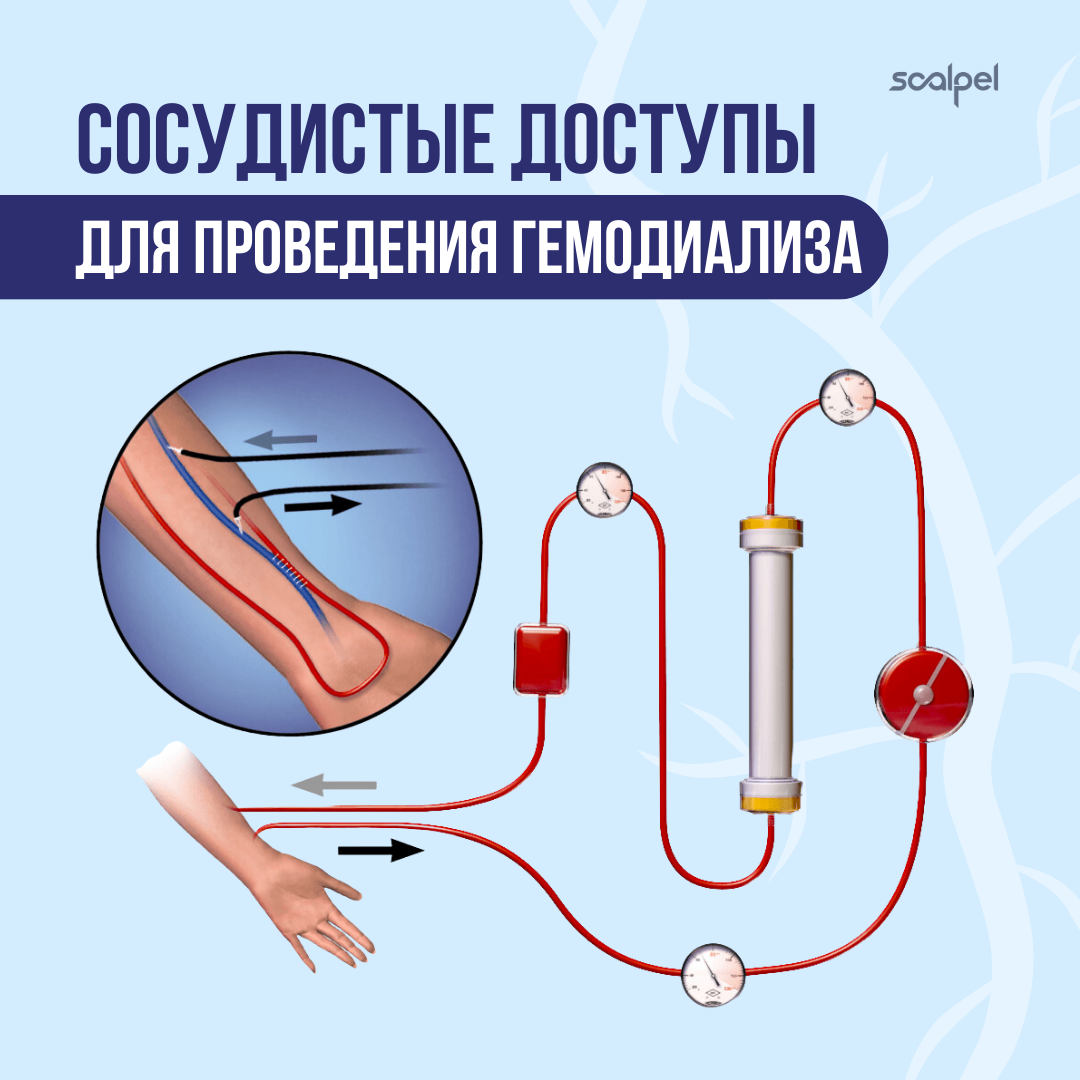 Гемодиализ фильтрация