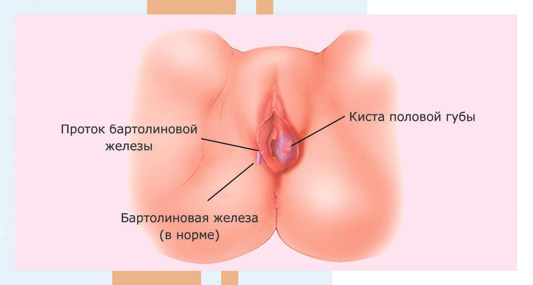 Иногда киста начинает отекать, из-за чего она может быть обнаружена объективным осмотром, без пальпации.