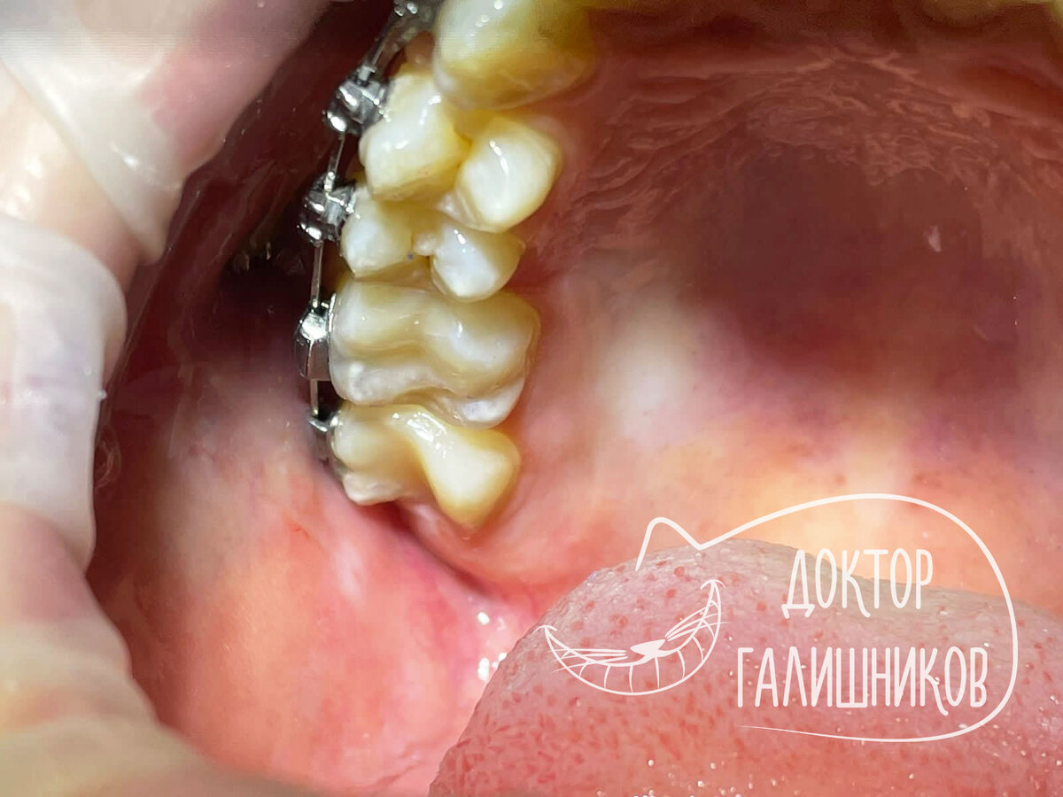 Как быть с кариесом во время ортодонтического лечения | Галишников Олег ...