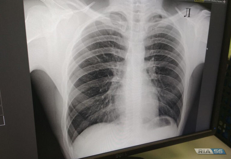    Оренбургские медики рассказали, как сохранить здоровье легких Белов Михаил Александрович