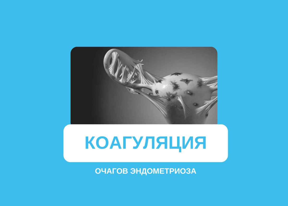 Коагуляция очагов эндометриоза