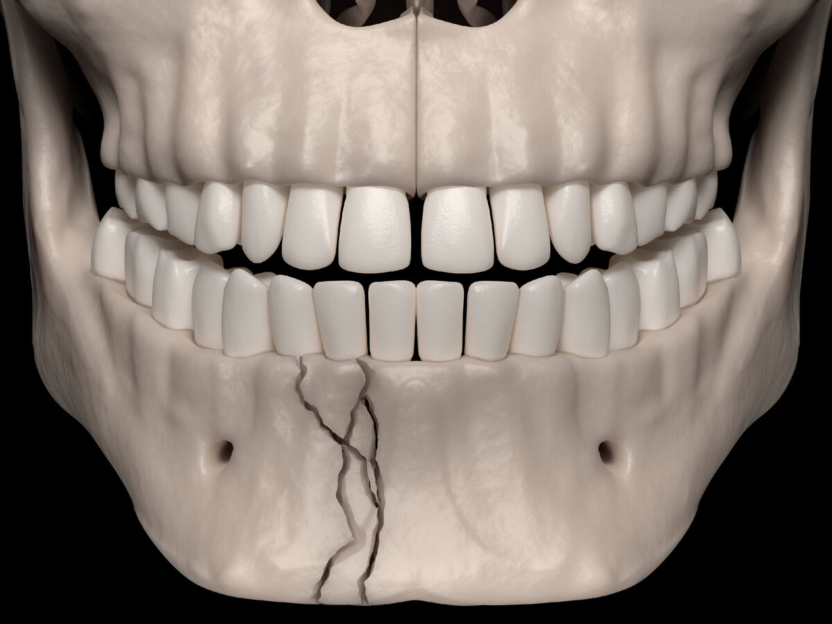 Перелом нижней челюсти