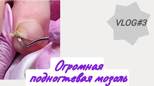 #shots #unboxing #vlog Огромная подногтевая мозоль/