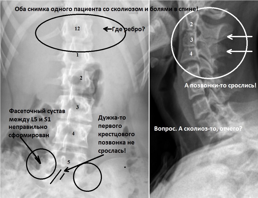 Лечебная физкультура при S - образном сколиозе