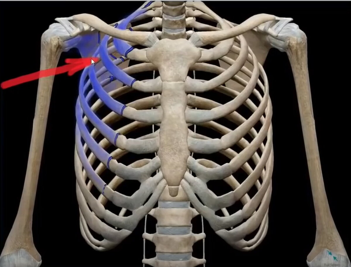 перелом ребра спереди. перелом ребра спереди. перелом 5 ребра рентген. признаки осложненного перелома ребер. перелом ребер грудной клетки.