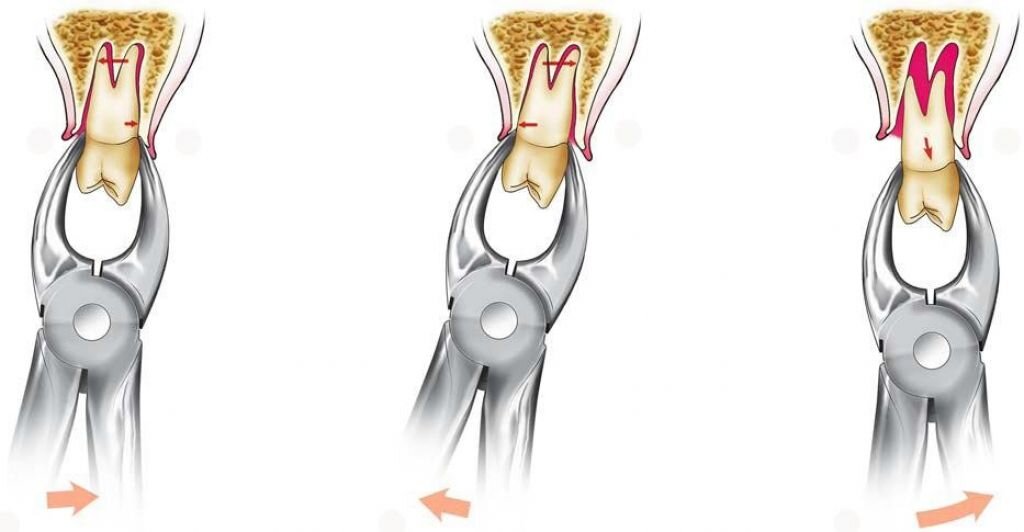 Этапы удаления. Люксация зуба на верхней челюсти.